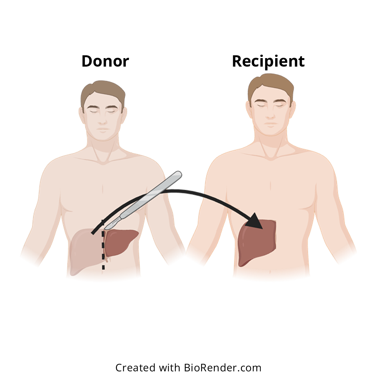 Evaluating the metabolic capacity of the liver in the donor and the recipient in the living-donor liver transplantation. 