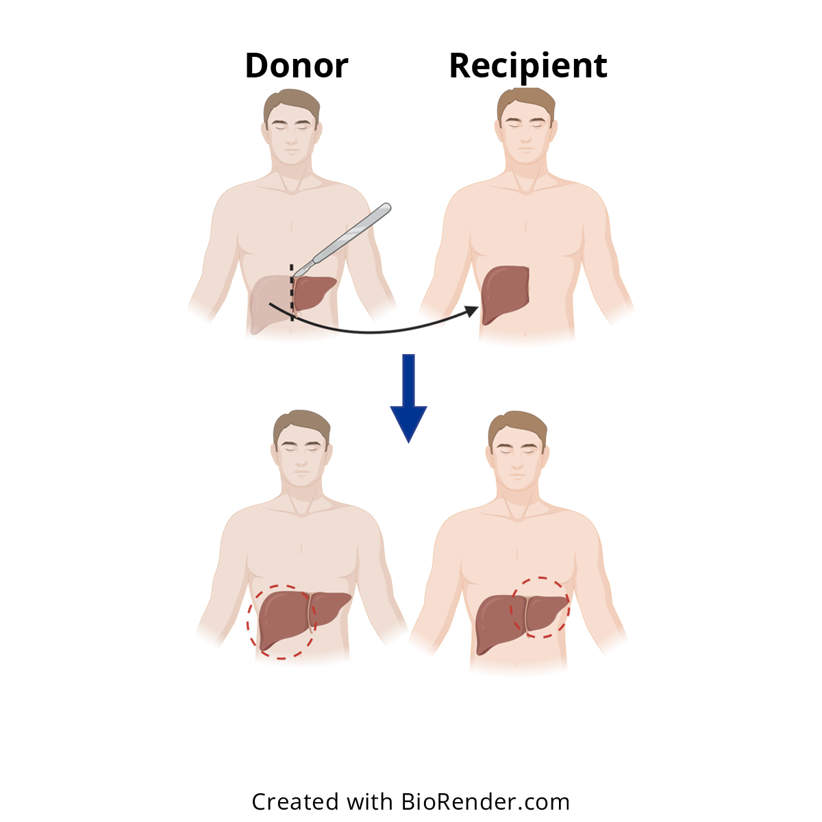 Metabolic function of the liver after LDLT